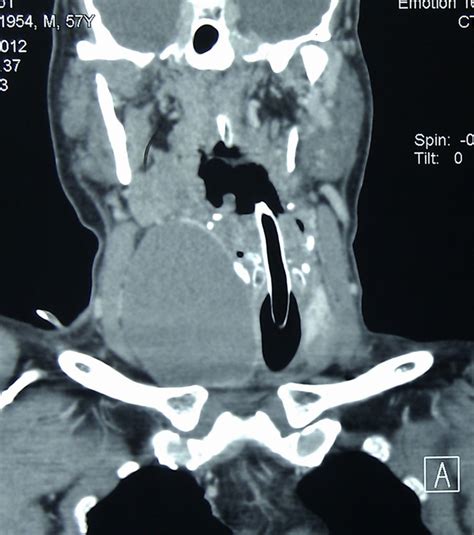 Case Report: Acute respiratory failure in a rapidly enlarging .